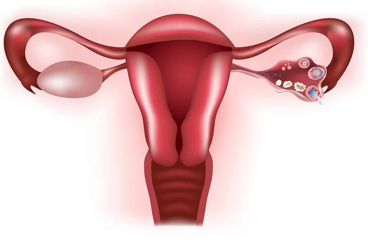 أضرار قرحة الرحم على المرأة مجلة البرونزية