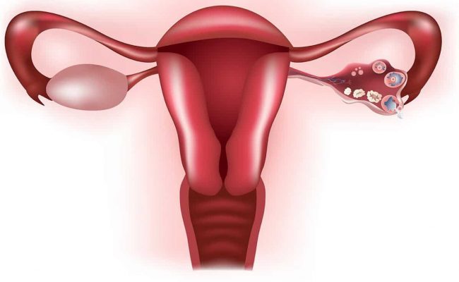 أضرار قرحة الرحم على المرأة