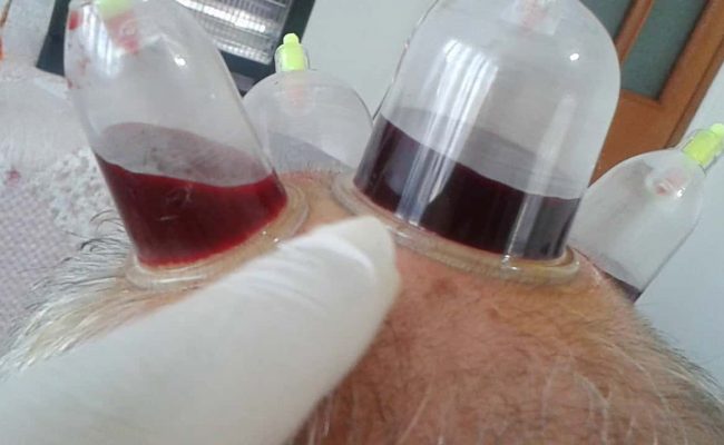 ما هي فوائد الحجامة في وسط الراس مجلة البرونزية