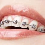 اضرار تقويم الزينة على الأسنان