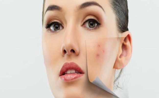 علاج البقع البينة في الوجه