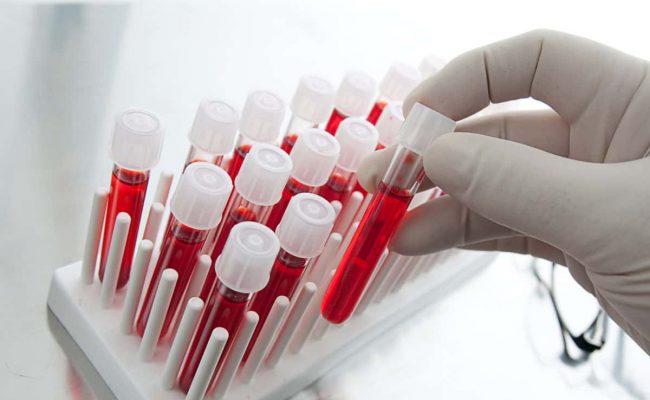 تحليل cbc تحليل الدم الشامل و الاستعداد له