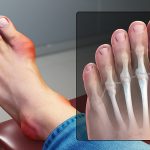 علامات تدل على اصابتك بالنقرس