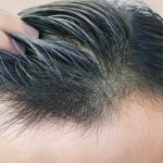 9 أفعال شائعة من الممنوعات بعد زراعة الشعر